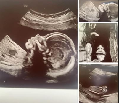 She revealed they were having a baby girl and shared photos of their ultrasound