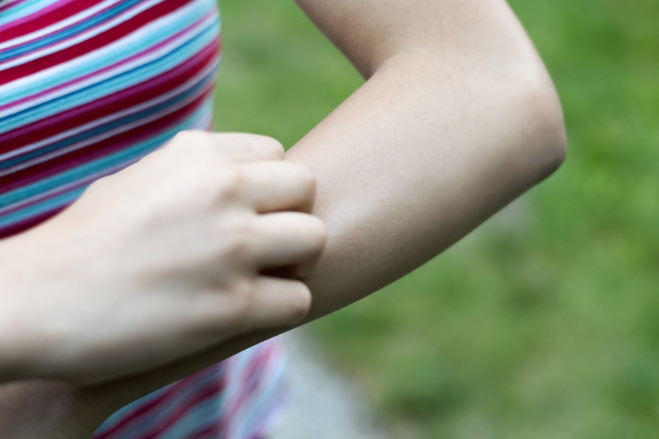 There are many home remedies that you can use to stop your insect bites from itching