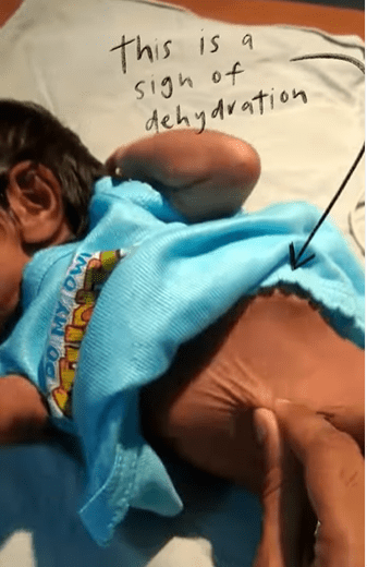 To do the test on your baby you should gently pinch their abdomen. If the skin stays up, almost like a tent, then it's a sign your little one is dehydrated