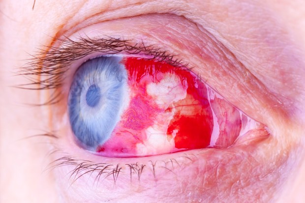 a close up of a person 's eye with a red pupil