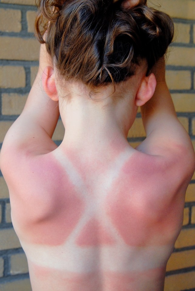 Sunburn can cause your skin a lot of grief over the years