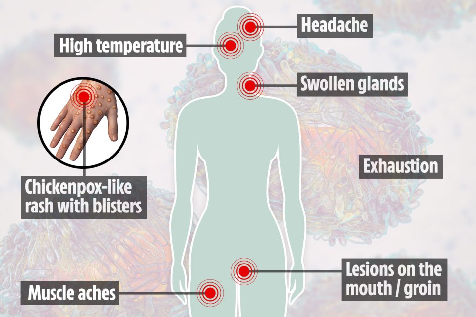 The chart above shows where monkeypox symptoms strike