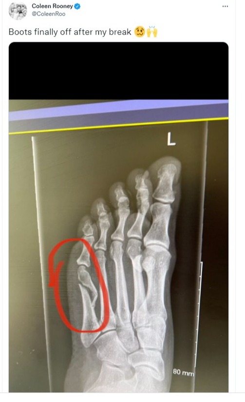 Coleen shared an x-ray of her broken foot on social media today, as she confirmed the boot is 'finally off'