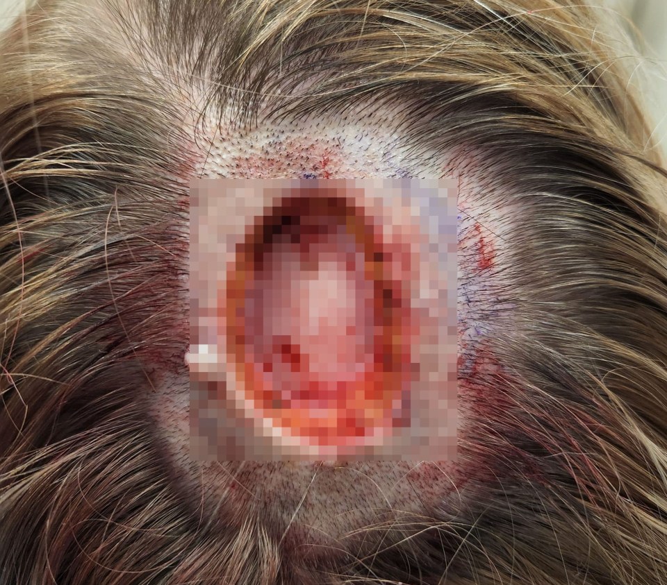 It was found to be melanoma and medics had to cut out the cancer, leaving her with a hole in her head which exposed her skull