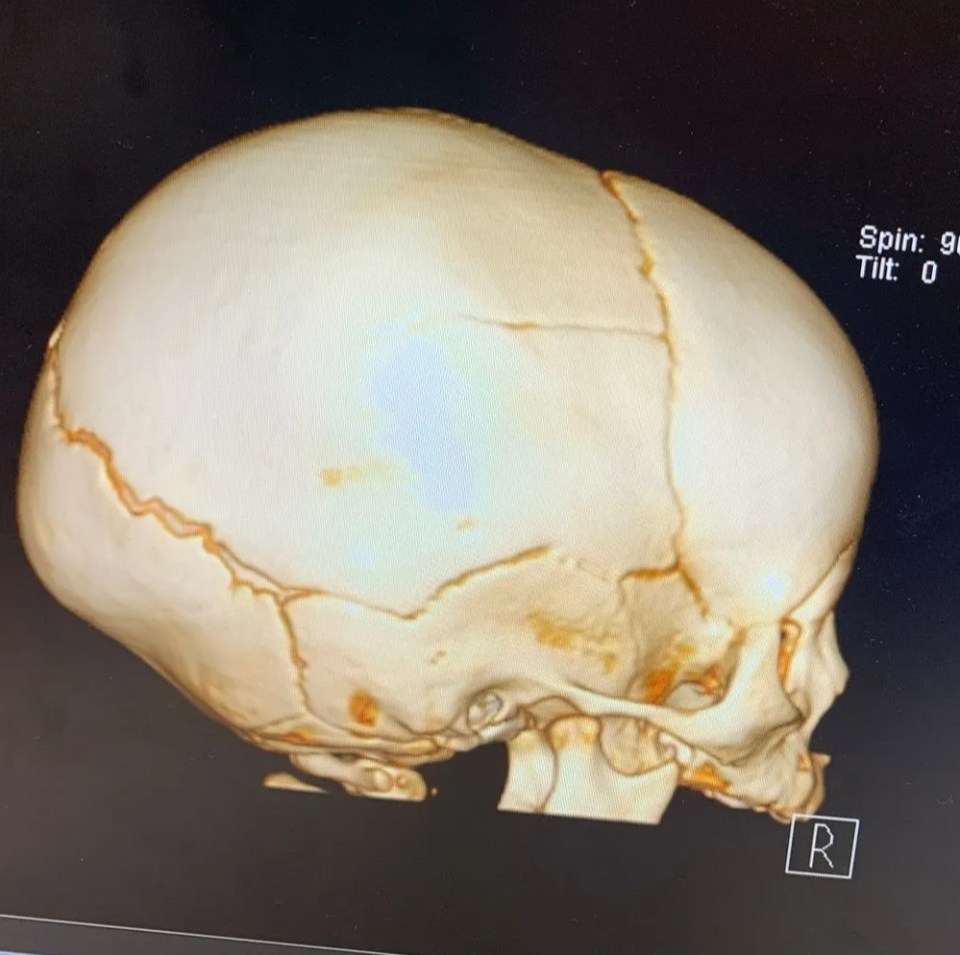 A mum shared a photo of her daughter's fractured skull after she fell suring nappy changing