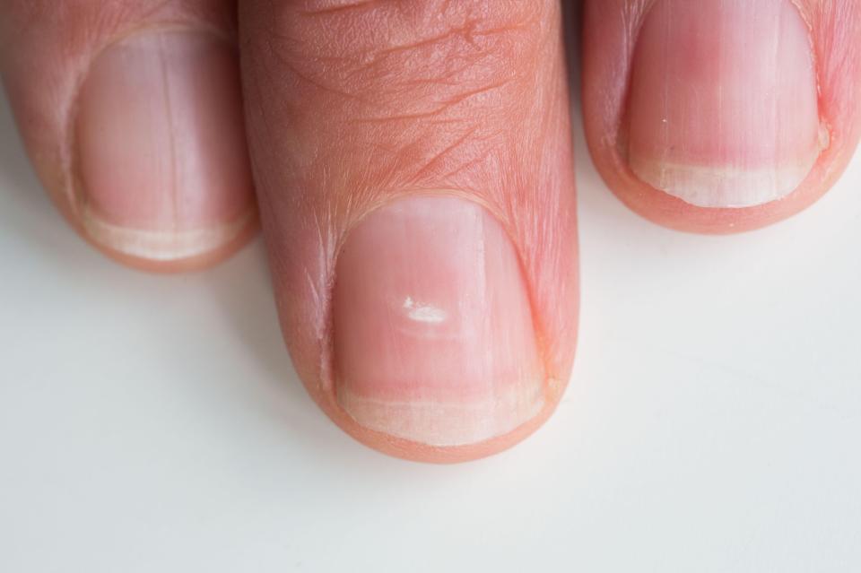 White spots on nails are very common. One cause is an underactive thyroid