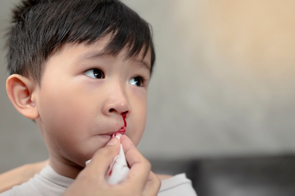 Nosebleeds can be distressing for children and one first aider has revealed exactly what parents need to do