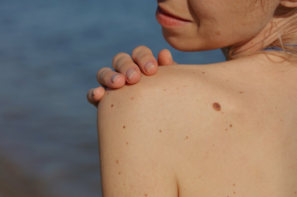 Regularly checking your moles mean you'll be alert to any changes in shape, size and colour, which could indicate melanoma