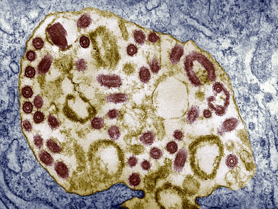 Marburg virus has killed five people in Tanzania