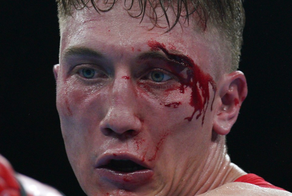 Boxer Billy McAllister suffered a horror 3cm cut above his left eye in his last-16 bout against Jamaica's Jerone Ellise