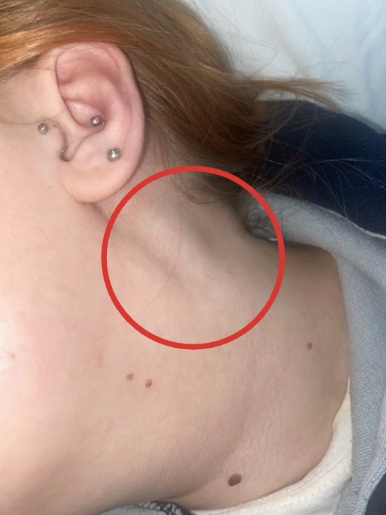 Rebecca's condition started with a rash, tiredness and a lump in her neck, pictured