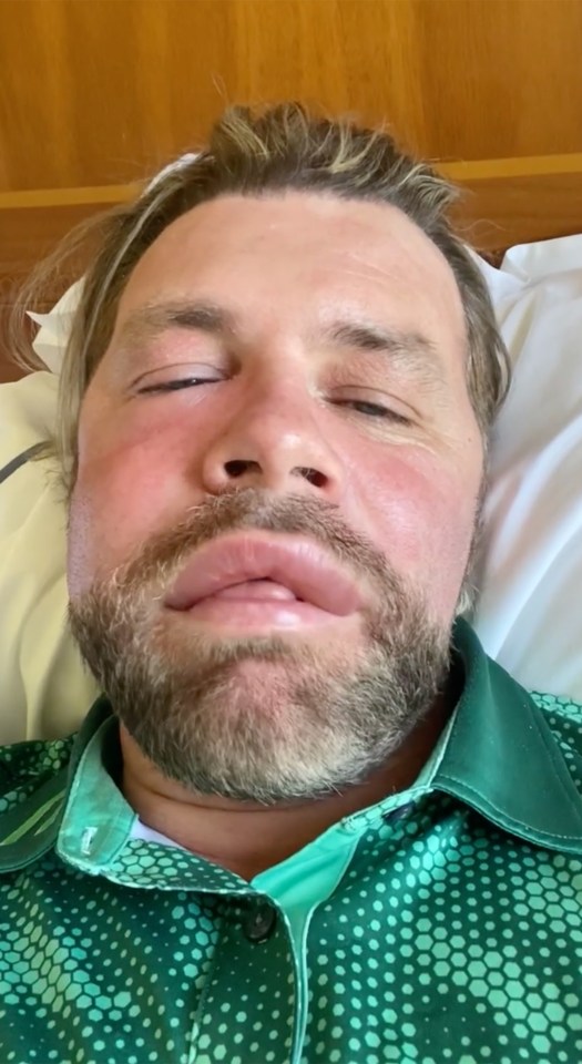 Brian McFadden shared a look at his bee sting allergic reaction