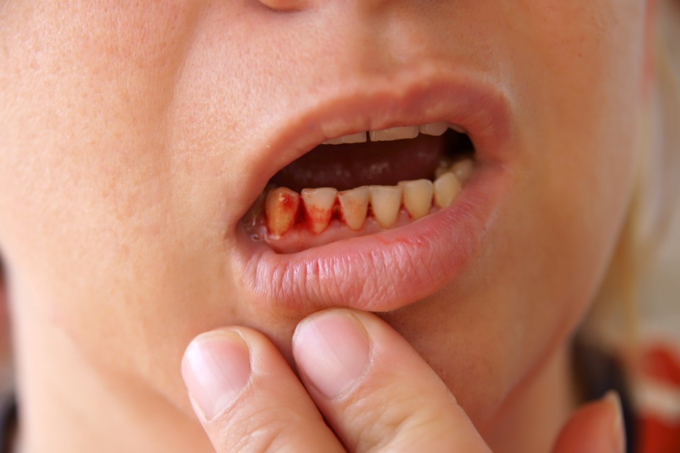 If gums are pale, receding or bleed when you brush, it could be a sign of periodontal disease