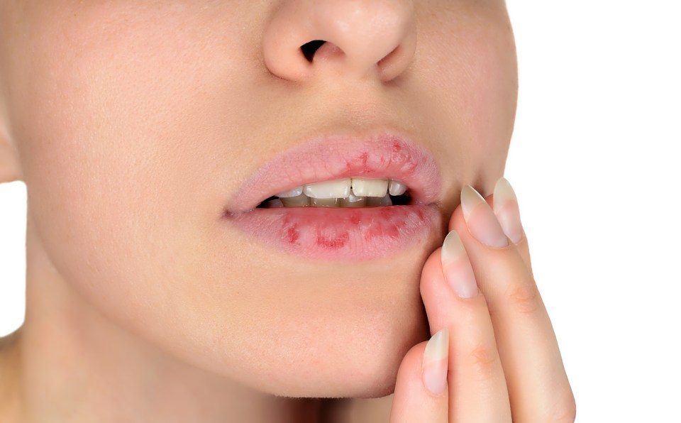 Cracks at the side of your mouth could be due to the condition angular cheilitis