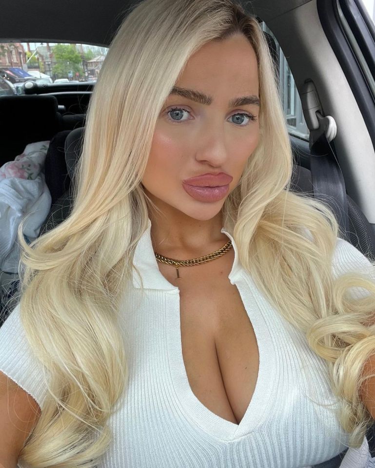 The former reality star is now unrecognisable thanks to her 'pregnant lips'