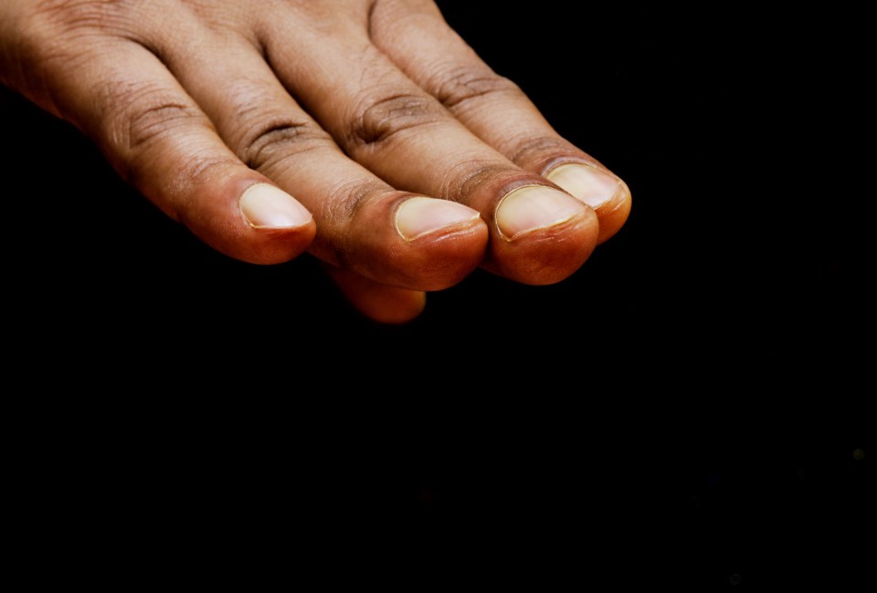 Clubbed fingernails