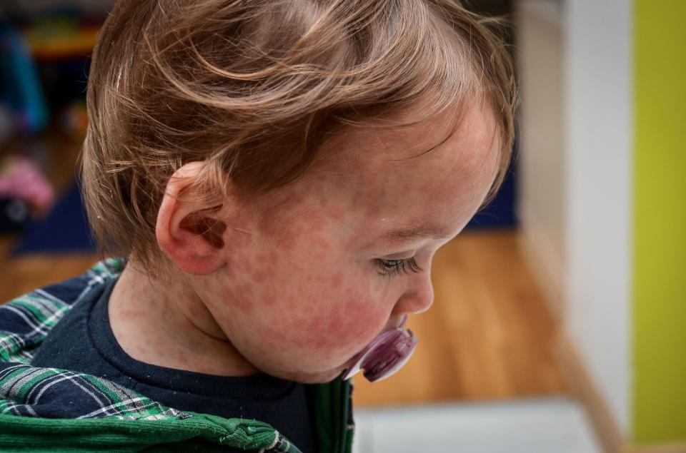 Most of us were vaccinated against measles, mumps and rubella in childhood – but check your child’s record, and your own