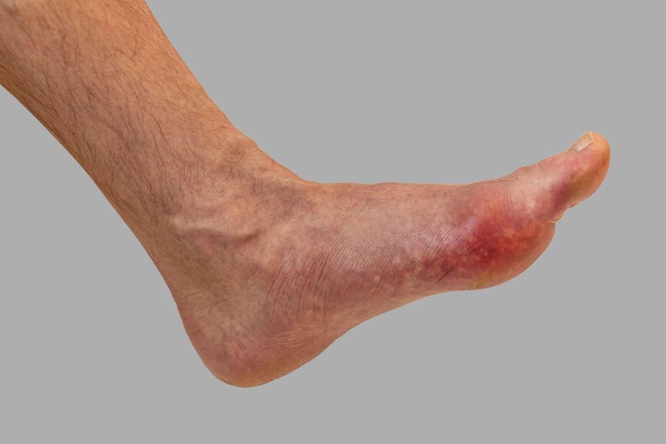 Gout, sometimes called the ‘king’s disease’, tends to strike in those who overindulge in rich, fatty food and alcohol