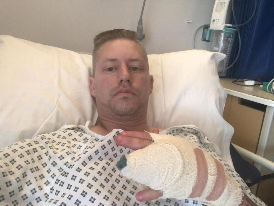 Adam Roberts almost lost his finger and needed hours of surgery after being bitten by a poisonous false widow spider