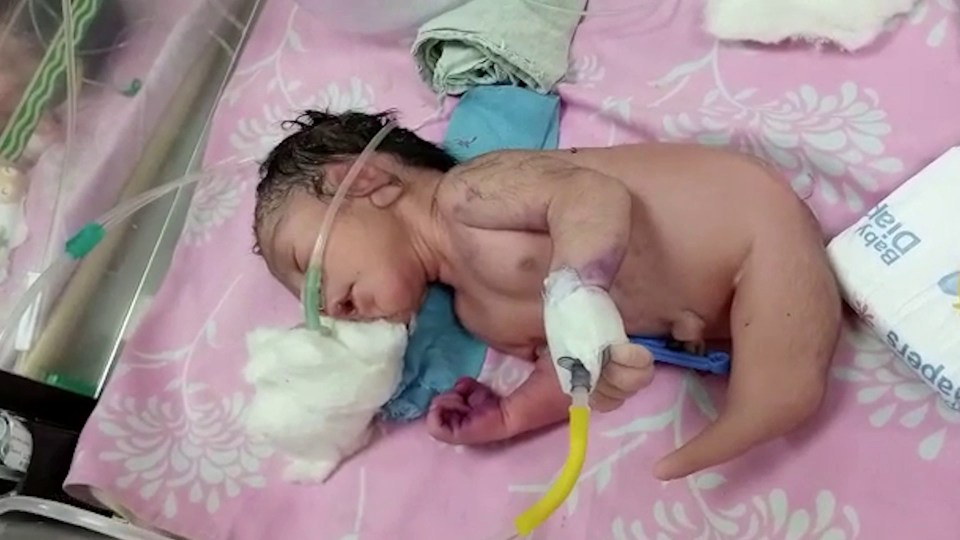 The infant was born in India with the incredibly rare health condition