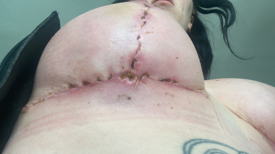 She had enormous scars after the surgery