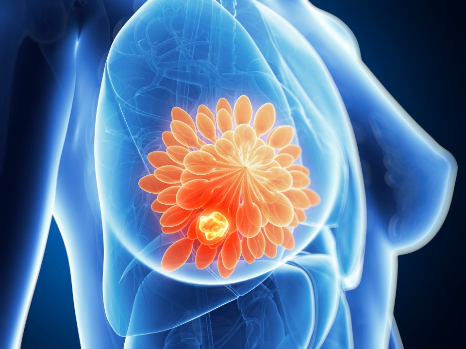 a computer generated image of a woman 's breast showing a tumor