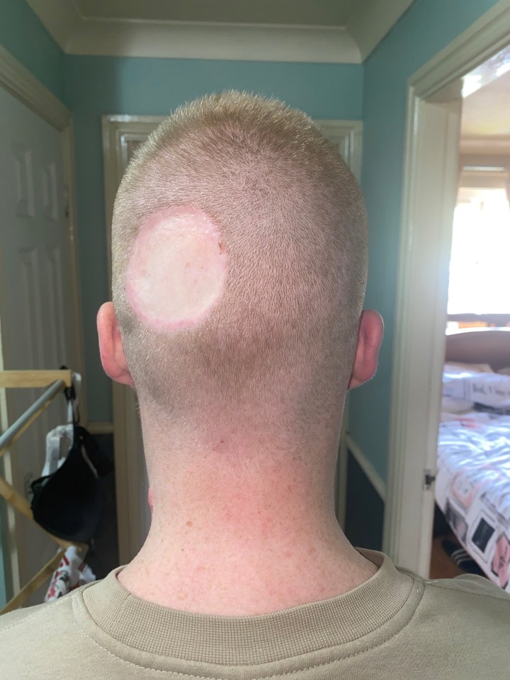 Elliot has been left with a large scar on the back of his head after having the melanoma removed