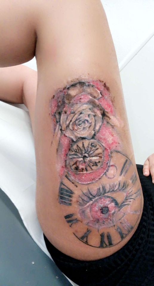 Her tattoo became horribly infected and left her struggling to walk