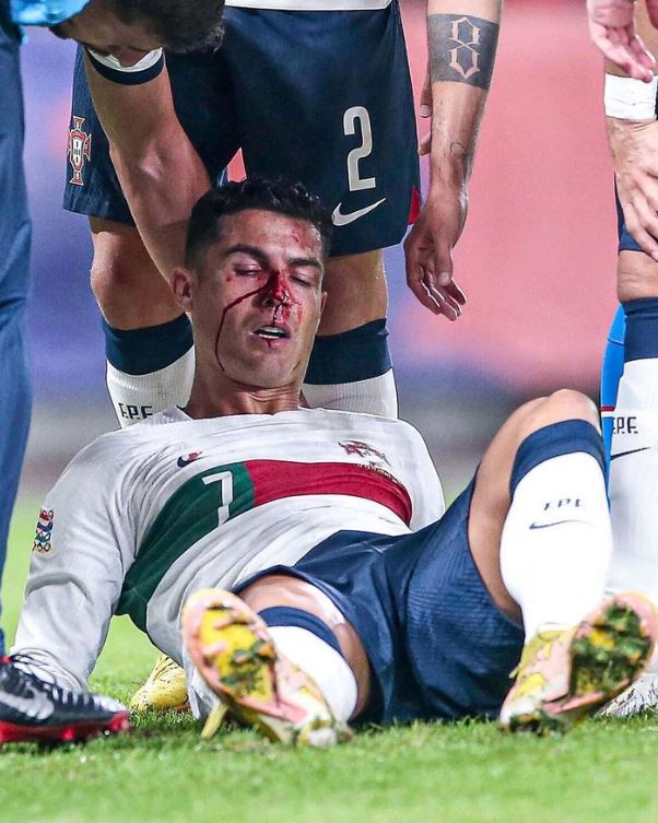 Ronaldo suffered a horror collision with goalkeeper Tomas Vaclik to leave him a bloody mess