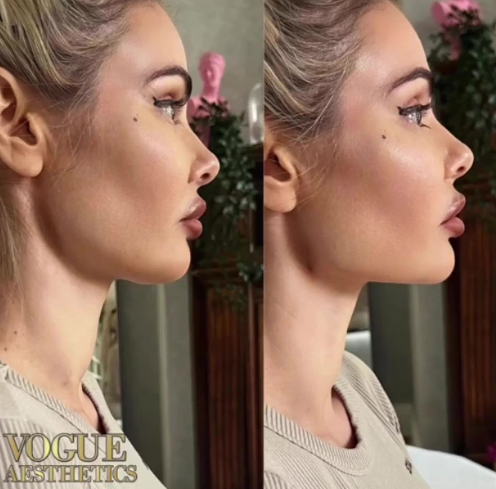 Chloe Sim had her lips and jaw done recently with her new look shown on the right