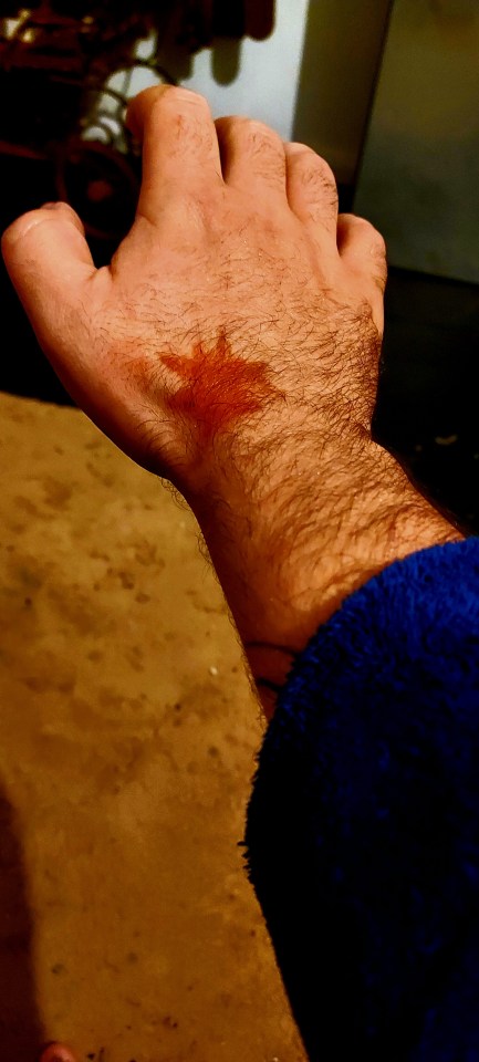 One of the ‘starburst-like’ burns on Aidan’s hand