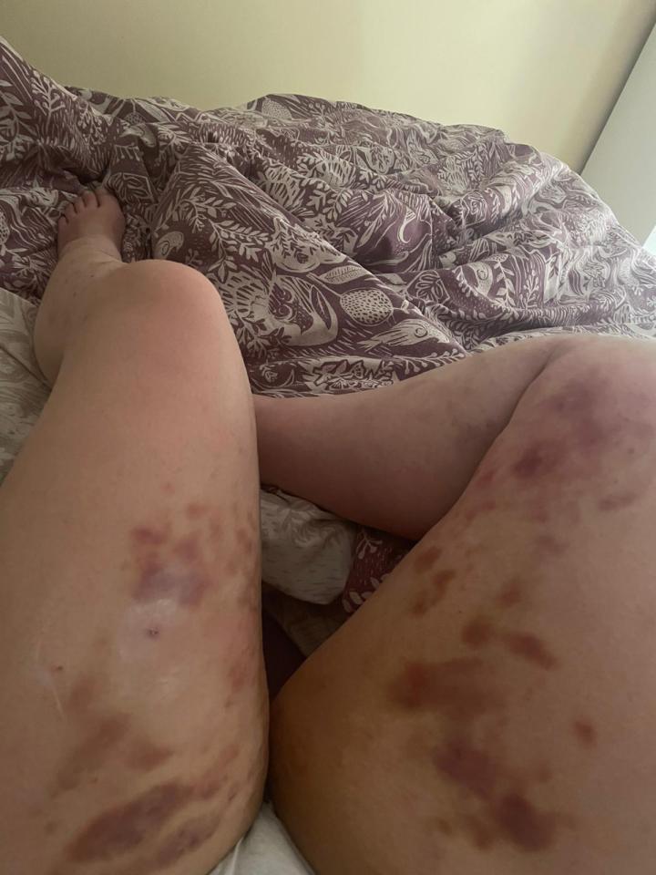 Tracy Keeble's legs five weeks after the initial bite