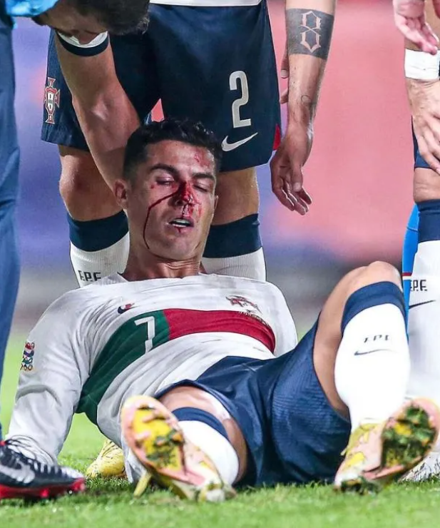 Cristiano Ronaldo was left with a cut and huge black eye after a nasty collision playing for Portugal