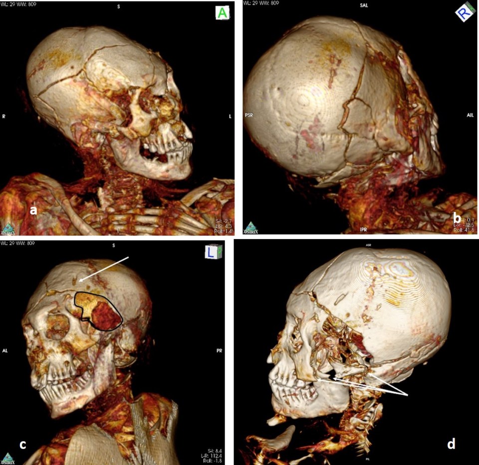 The scans revealed that two mummies had been brutally murdered