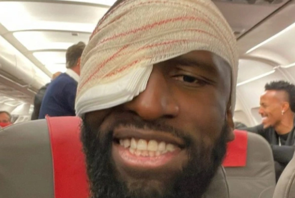 Antonio Rudiger hurt his eye and head in the Champions League