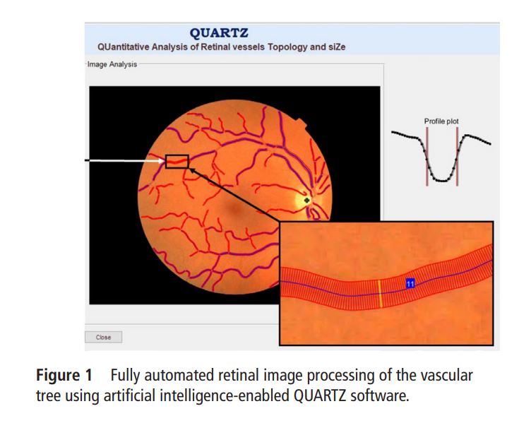 The image above shows the retina in the black box (left). The small box on the right shows how the AI technology measures the thickness of an artery at the back of the eye