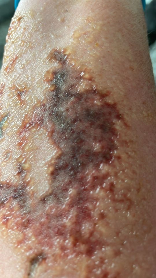 The burns did not need to be treated with skin grafts