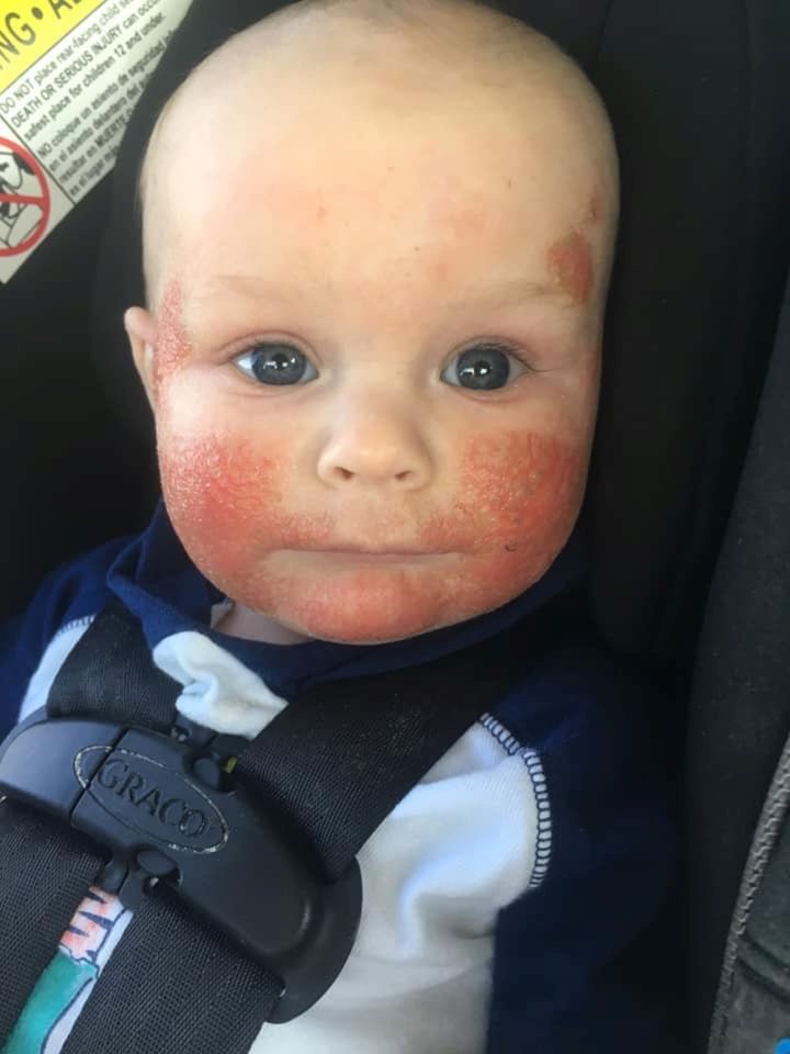 The tot's eczema held him back from a lot of things as he struggled to gain weight