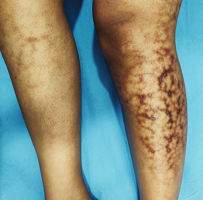 The image above shows the legs of a 24-year-old woman who had been using an electric heater during the winter months