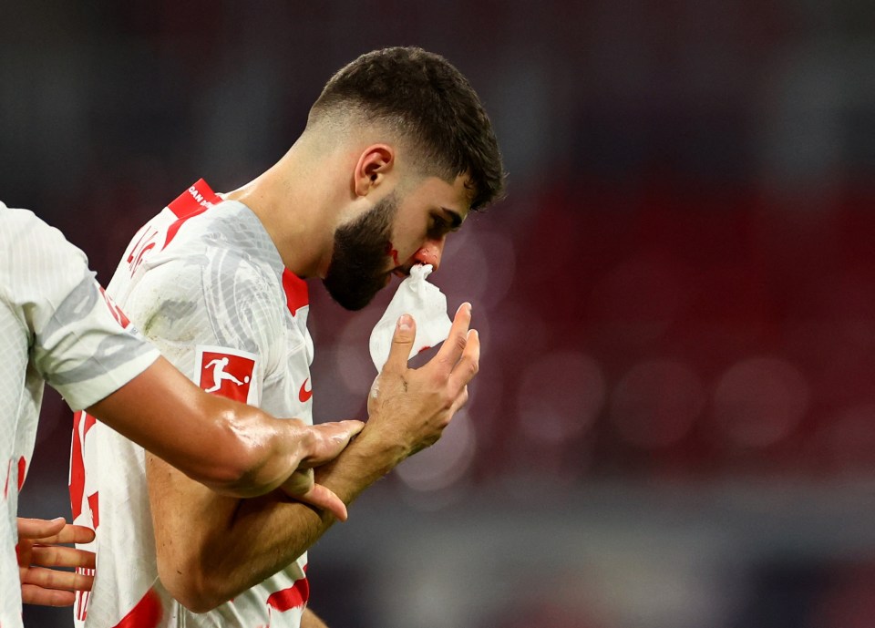 Josko Gvardiol had a bloodied nose after a nasty collision with a team-mate during Leipzig's 3-1 win over Freiburg