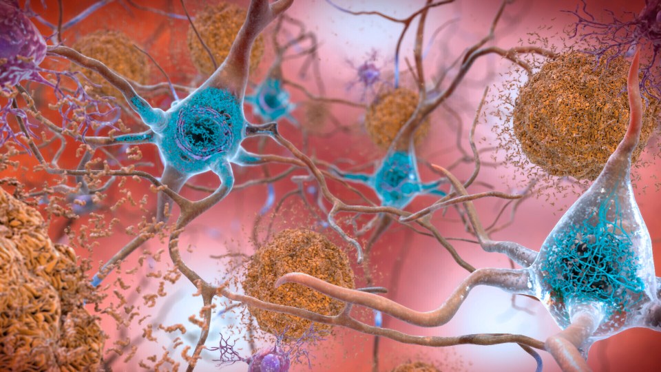 In Alzheimer's disease, two proteins build up which causes brain cells to die