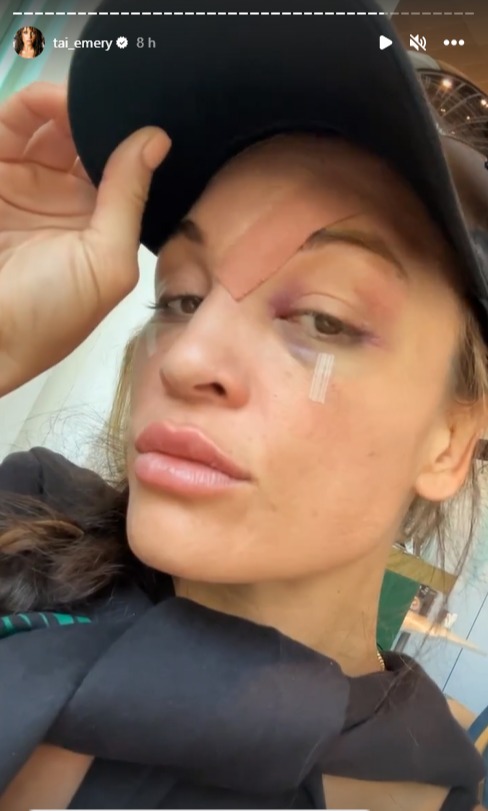 Tai Emery suffered gruesome facial injuries in her first-ever defeat