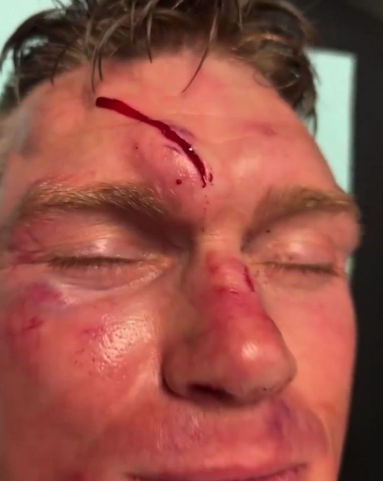 Thompson ended up with two nasty cuts on his head