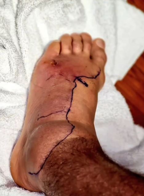 Dustin Poirier was left with a swollen foot due to his staph infection