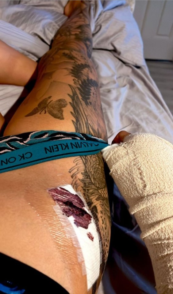 Ebanie Bridges revealed the flesh which was taken from her hip to help fix her broken hand