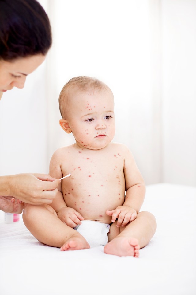 Keep your kids hydrated and give them cooling creams if they get chickenpox