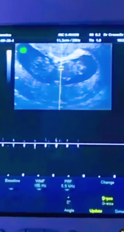 She shared a video of her ultrasound scan