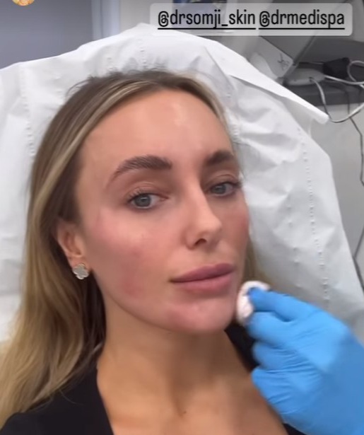 The Towie star showed off her bruised and swollen face