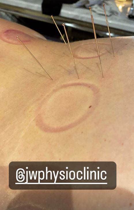 The star later turned to accupuncture to treat her pain relief