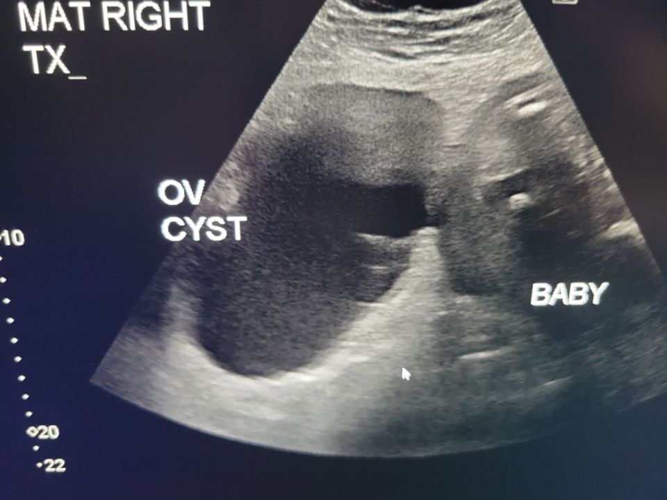 An ultrasound scan revealed that the ovarian cyst was bigger than the baby she was carrying